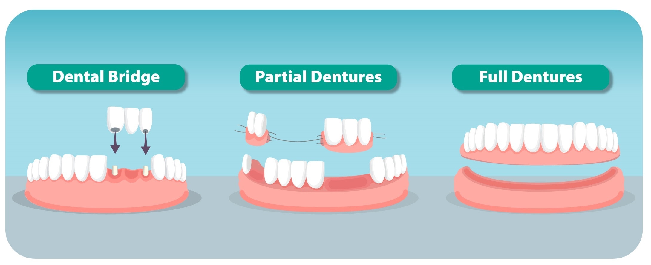 Denture and dental bridge