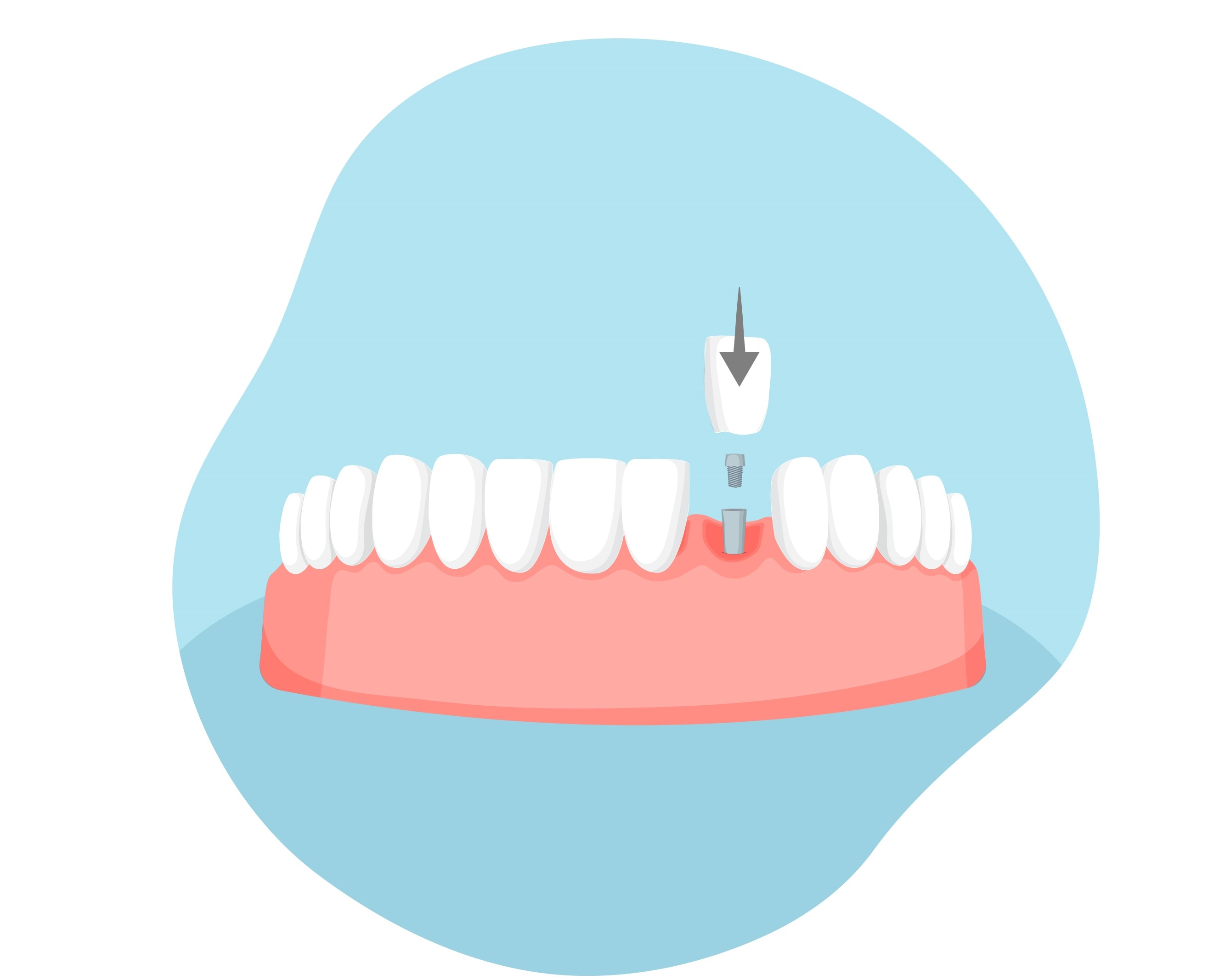 dental implant