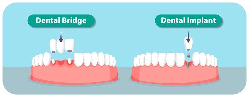 Dental Bridge Vs Dental Implant: Which To Choose – YPSY